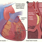 Heart Attack Image